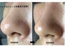 メディカルサロンドオフ 堺東店(medical salon de off)/水素毛穴洗浄♪