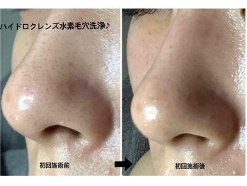 メディカルサロンドオフ 堺東店(medical salon de off)/水素毛穴洗浄♪