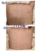 ジェニックサロン グランドギンザ ひたちなか(GENIC SALON GRAND GINZA)/頑固な背中のニキビケアも◎