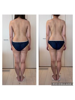 ハートエルボー(Heart elbow)/1ヶ月痩身結果