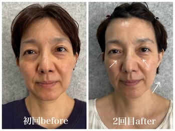 ルー ハナレ 神戸岡本 摂津本山店(Luu HANARE)/初回ビフォー２回目アフター