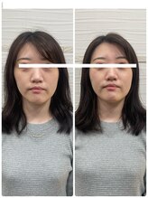 長寿鍼灸院 長寿整骨院/美容鍼50本の効果★小顔効果