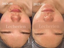 ルシェリア(Le cherien)/ハーブピーリング施術３回