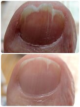 あし処 トコトコ(tocotoco)/薄爪・割れ爪補強