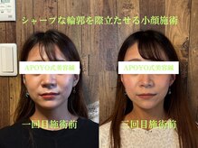 アポヨ鍼灸院(APOYO鍼灸院)/シャープな輪郭際立たせ小顔施術