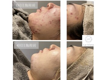 ラヴィオーラ 神戸兵庫店(La Viora)/ダイヤモンドハーブピーリング