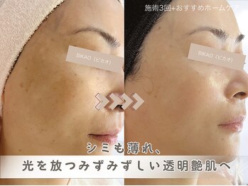 ビカオ(BIKAO)/ハーブピーリング