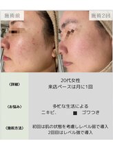サロンエヌ 久留米店(Salon N)/ニキビケア/跡改善