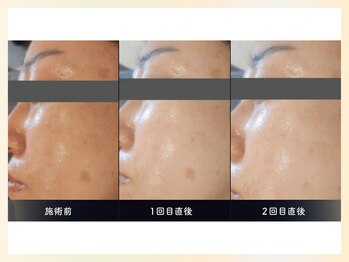 ソウナ(SONA)/ララピール上位版☆ダクトピール