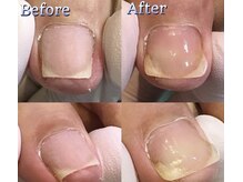 ケアビューティサロン(care beauty salon)/巻き爪ジェル