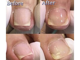 巻き爪ジェル