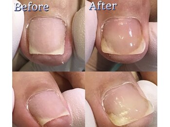 ケアビューティサロン(care beauty salon)/巻き爪ジェル