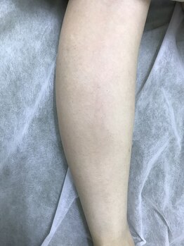 ナノハナ/鹿沼市の全身脱毛のナノハナ