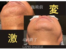 ラピスダズル(LAPIS DAZZLE)/ヒゲ脱毛☆途中経過