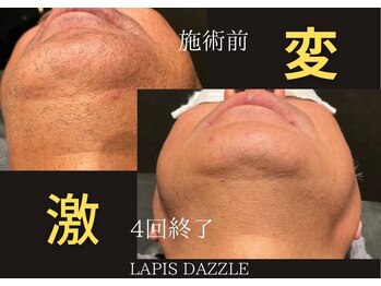 ラピスダズル(LAPIS DAZZLE)/ヒゲ脱毛☆途中経過
