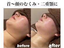 ウィズルーチェ 神栖店(with luce)/１回の変化で小顔効果！二重顎編