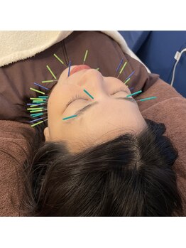 蒼月(aotsuki)/美容鍼