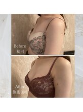 プレミドール(PREMIDOLL)/Before After/施術3回