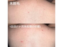 エピジュ(Epijyu)/男性の背中脱毛