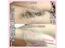 サロン(SALON)/メンズ脱毛：ワキ