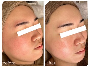 ベル(Bell)/光フェイシャルで小顔効果！