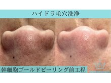 リメイククリニカルビューティー(Remake clinical beauty)/にょきにょき角栓