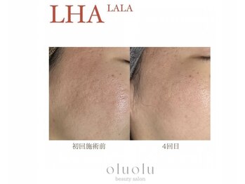 オルオル(oluolu)/LHALALAPEEL