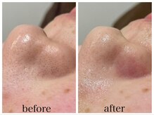 アリエス/ハイドラ×顔脱毛１回の変化