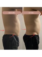 美容痩身ラボ 松山院/施術経過