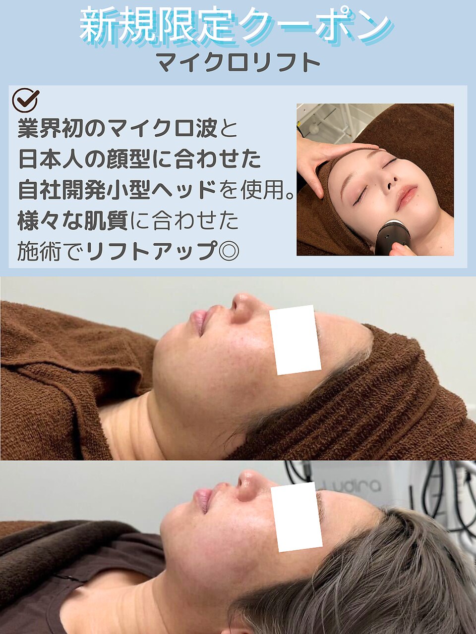 【DTなし！渡韓なし！/医師監修】余分な脂肪撃退！小顔マイクロリフト
