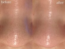 ホワイトアクア 梅田本店(WHITE AQUA)/ハーブピーリング/毛穴洗浄/梅田