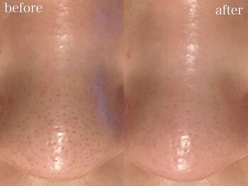 ホワイトアクア 梅田本店(WHITE AQUA)/ハーブピーリング/毛穴洗浄/梅田