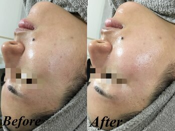 リララ 江坂店(Lelala)/艶肌ワックス☆ビフォーアフター