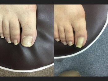 【巻き爪/深爪/フットケア】巻き爪本舗　津田沼店/こんなに綺麗になります！