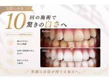 ホワイトニングショップ 立川店の雰囲気（施術効果のお写真です♪）