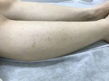 ナノハナ/鹿沼市の全身脱毛のナノハナ