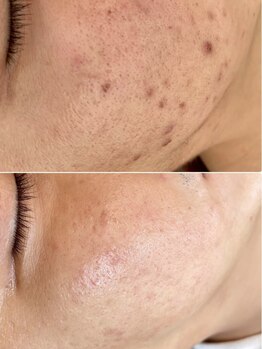 エレヌイ(ELENUI)/最新光フェイシャル★ニキビケア