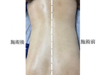 ホーミー(Homie)/背中美人★筋膜リリース