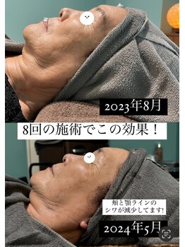 アンベリー ひびきの(embellie)/リフトアップケア