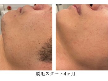 ヘルバ(HERBA)/脱毛