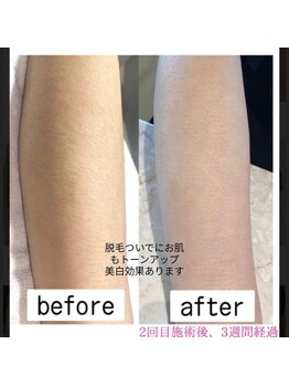 エム(M)/全身脱毛