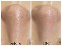 アリエス/ハイドラ×顔脱毛１回の変化