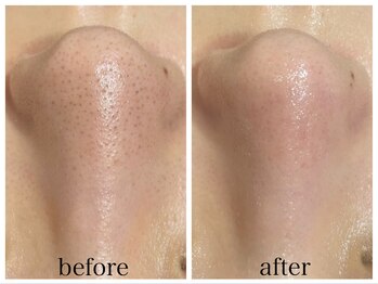 アリエス/ハイドラ×顔脱毛1回の変化