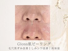 アネラボーテ(Anela Beaute)/Gloss肌ピーリング/いちご鼻改善