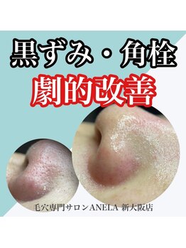 アネラ(ANELA)/毛穴エクストラクション　症例4