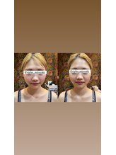 ビプラス(VIPLAS)/小顔メニュー