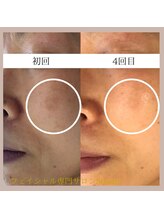 ソラリス(solaris)/シミケア