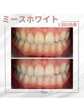 ミースホワイトニング(mys whitening)/ビフォーアフター【歯科提携】