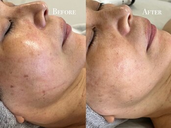 イースト(EAST)/シミプラズマフルコース8回