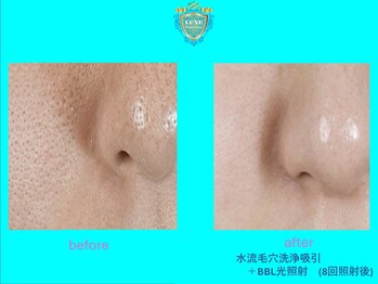 リュクス(LUXE)/ビフォーアフター